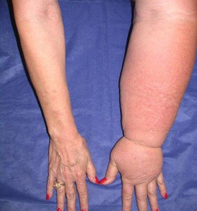 lemfoidima